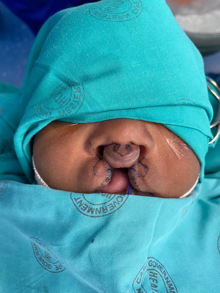 Imolathile Mbeka before reconstructive surgery for his bilateral cleft lip.