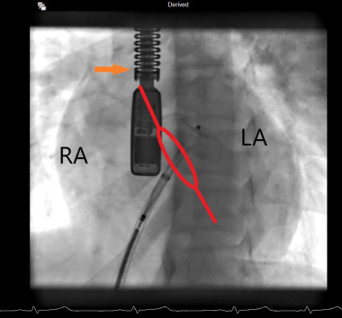 Tygerberg Hospital Congenital Heart Defects awareness week - X-ray images of young girls heart