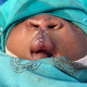 Imolathile Mbeka (at age 4 months) after reconstructive surgery for his bilateral cleft lip.