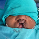 Imolathile Mbeka before reconstructive surgery for his bilateral cleft lip.