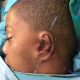 Marciano Hanekom (age 15) born with left sided microtia (absent ear) during reconstructive using his own rib cartilage.