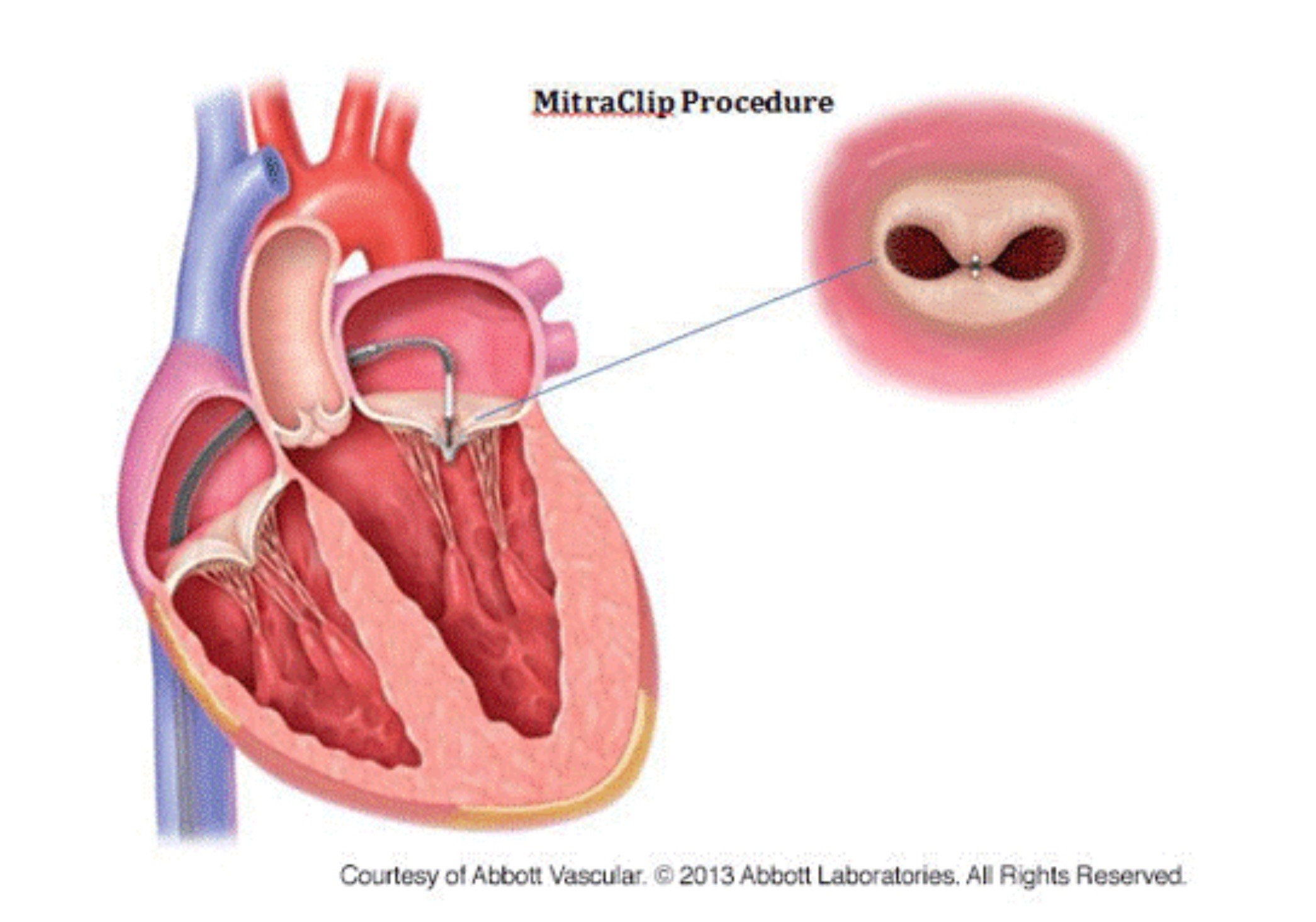 Graphic illustrating the MitraClip procedure.